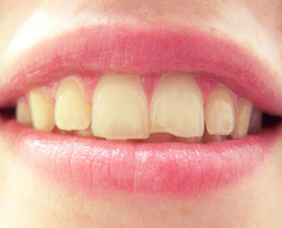 How to Fix a Chipped Tooth  The Center for Cosmetic Dentistry