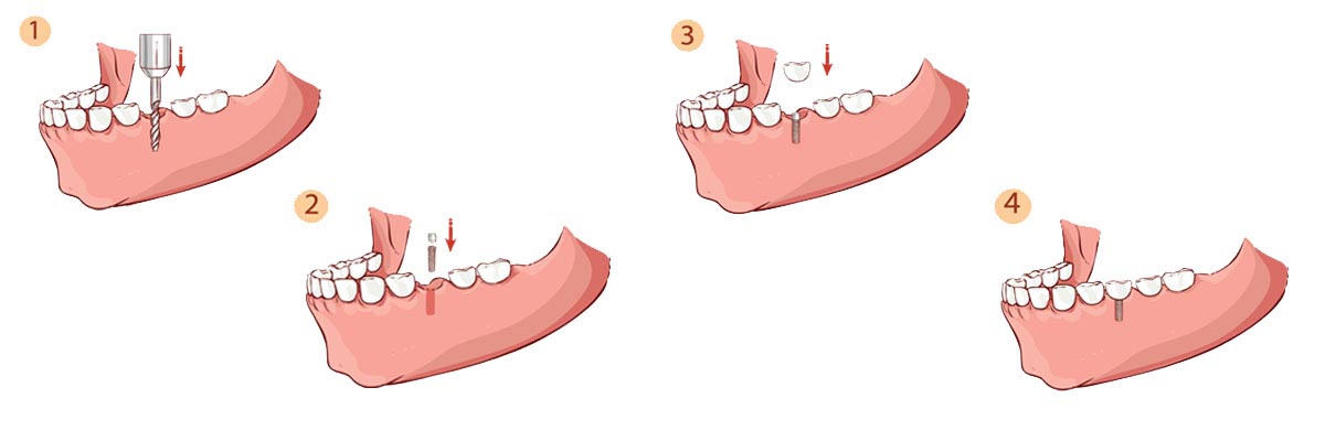 Santa Clara The Dental Implant Procedure
