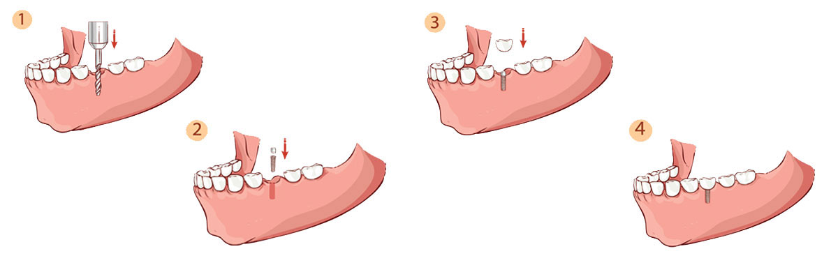 Santa Clara Dental Implant Restoration