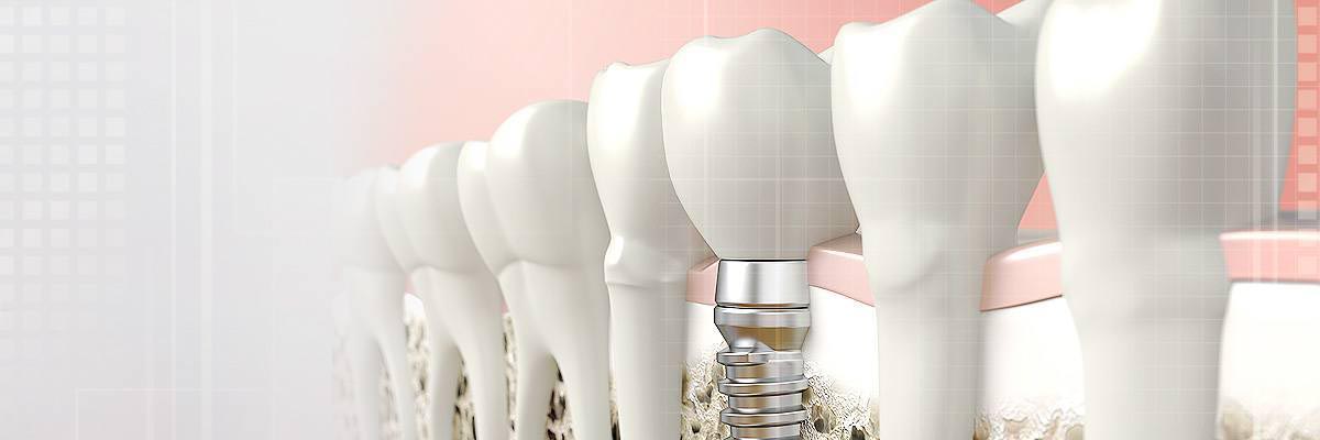 Santa Clara Dental Prosthetics