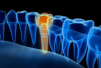 Implant Dentist