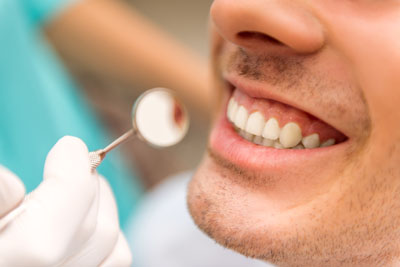 Dental Fillings