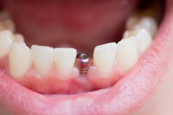 Implant Dentist Santa Clara, CA