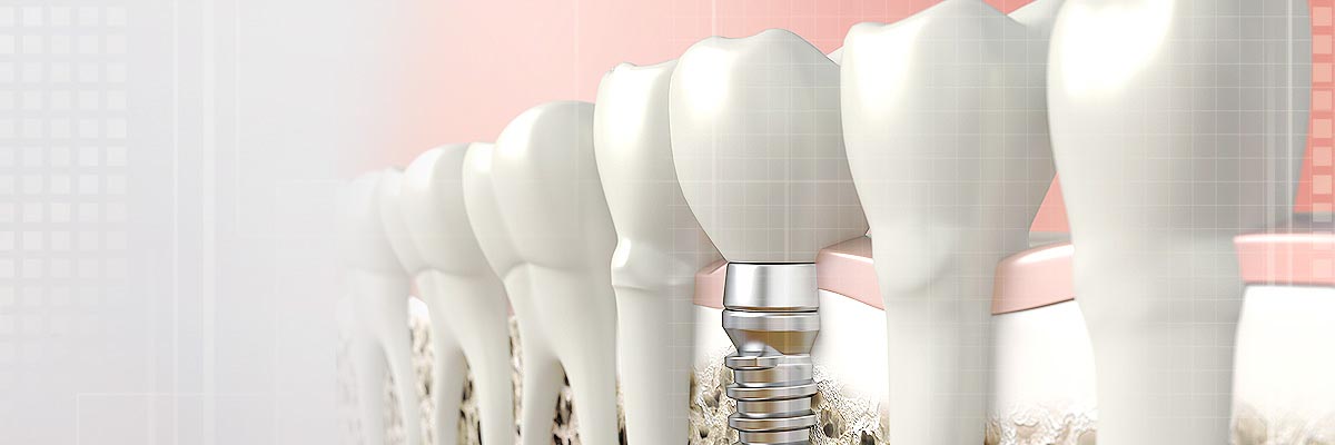 Santa Clara Implant Dentist