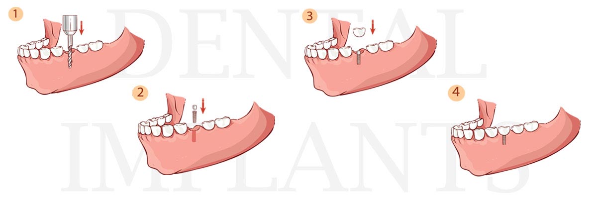 Santa Clara The Difference Between Dental Implants and Mini Dental Implants