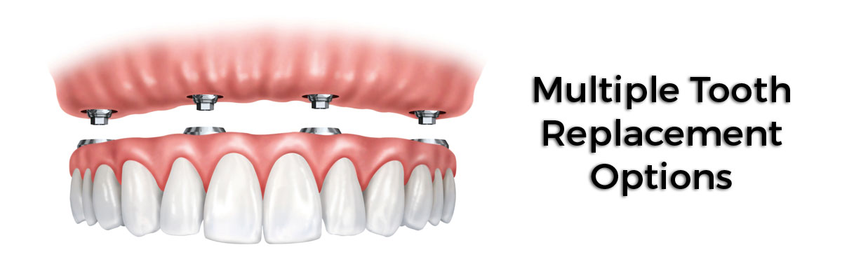 Santa Clara Multiple Teeth Replacement Options