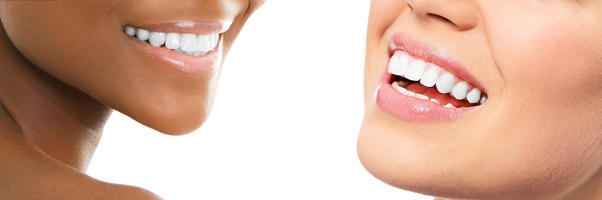 Santa Clara Teeth Whitening