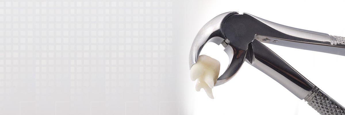 Santa Clara Tooth Extraction