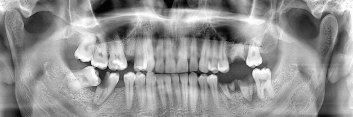 Santa Clara Wisdom Teeth Extraction